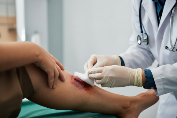 Royal Wound Care physician cleaning and dressing an open leg wound during wound care treatment Royal Wound Care physician cleaning and dressing an open leg wound during wound care treatment