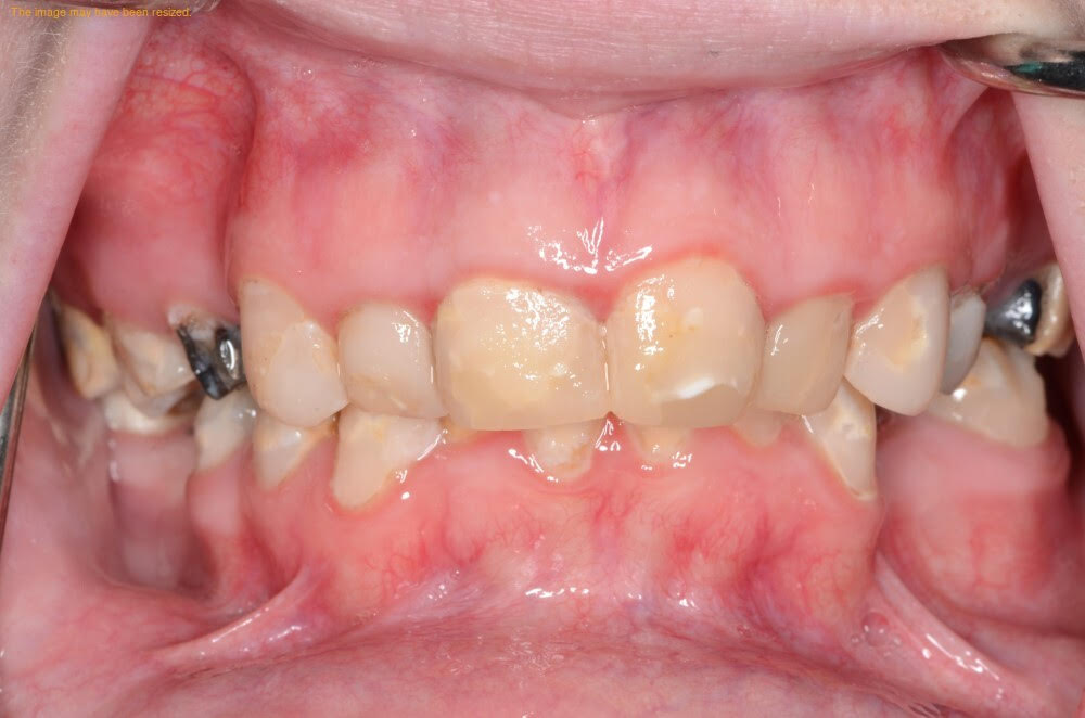 Before hybrid dentures treatment showing damaged and missing teeth