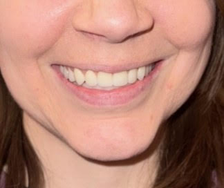 After hybrid dentures treatment showing beautiful, natural-looking smile