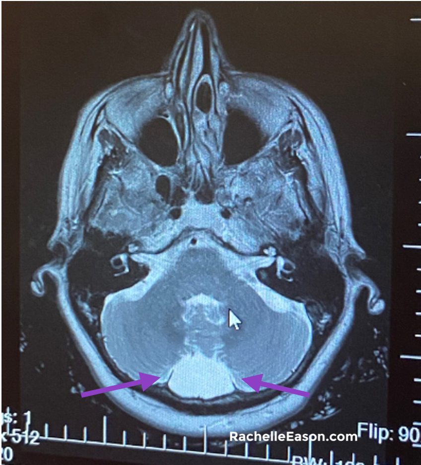 Arachnoid Cyst MRI