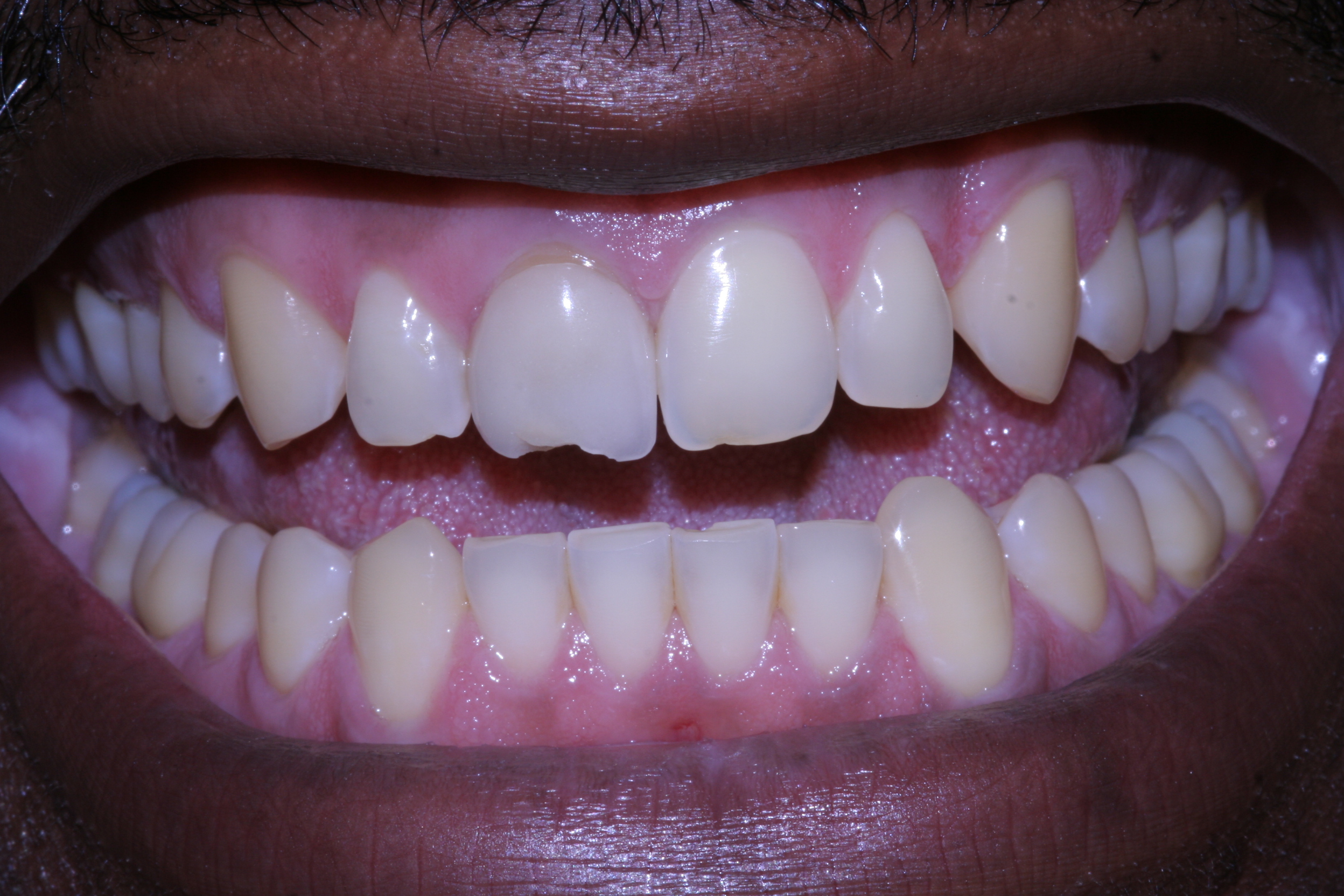 After Smile