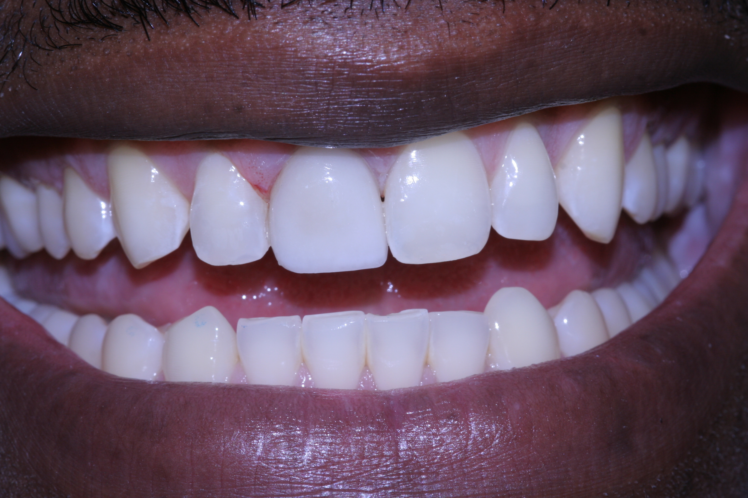 Before Smile