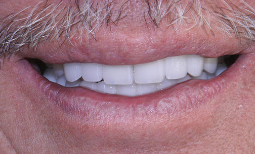 Before Smile