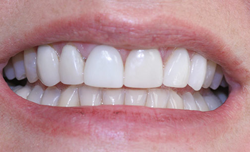 After Smile