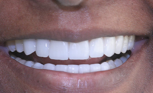 Before Smile