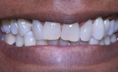 After Smile