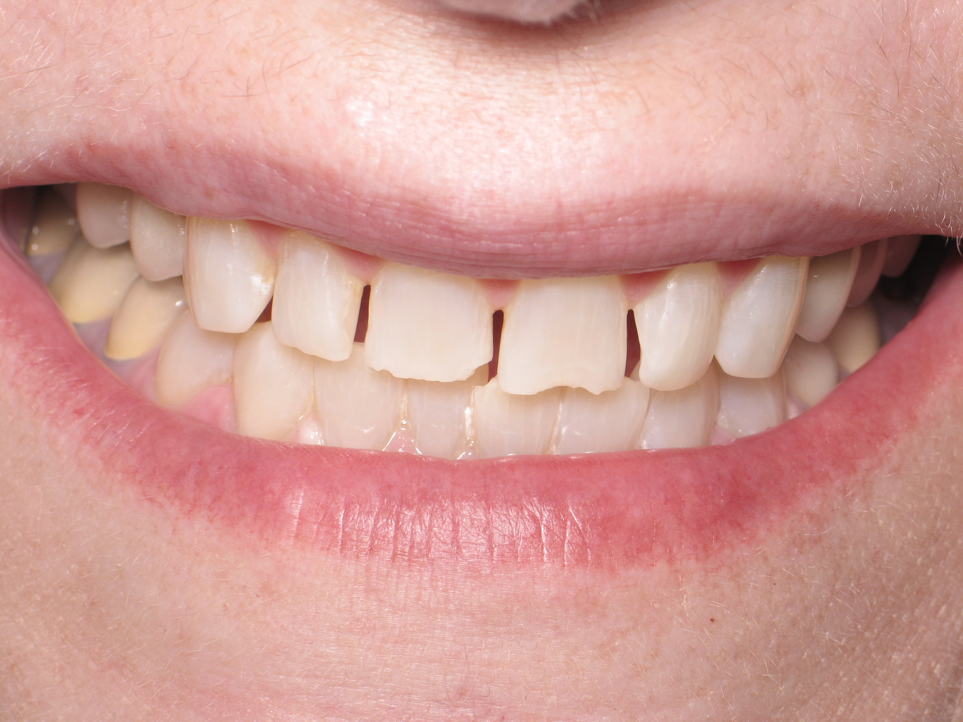 After Smile