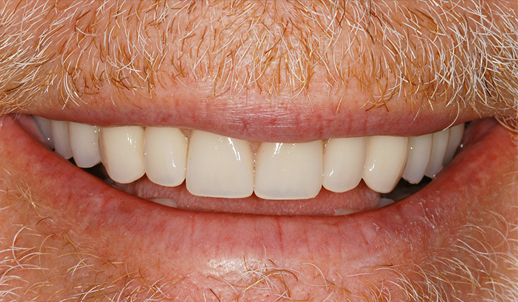broken teeth before dentures are put in