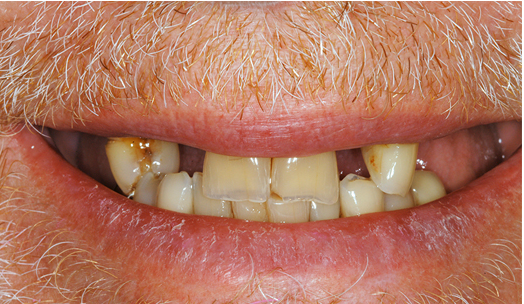 fixed beautiful teeth after dentures are put in