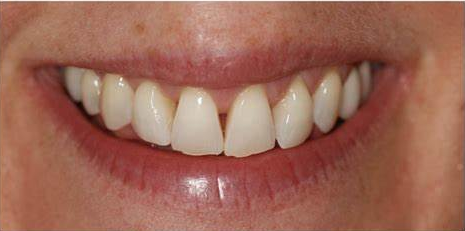 beautiful and even teeth after composite bonding is applied