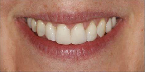 gaps between teeth before composite bonding is applied