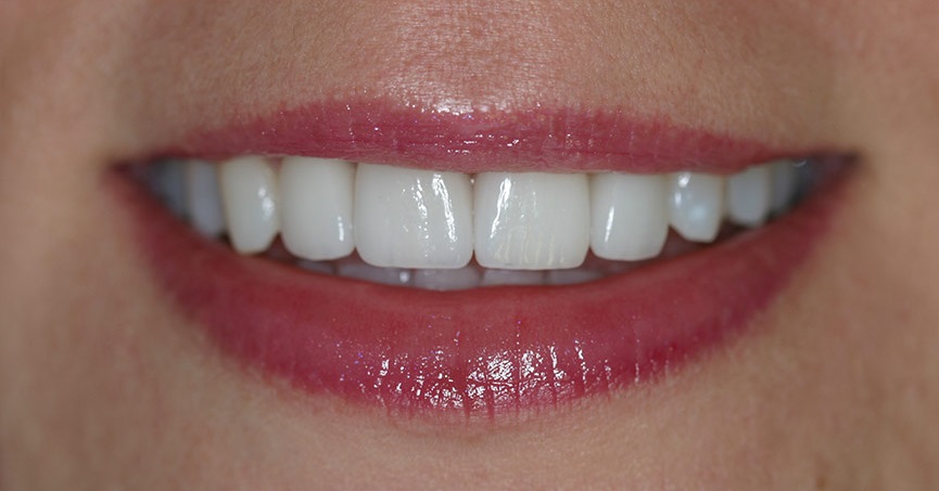 beautiful and even teeth after composite veneers is applied