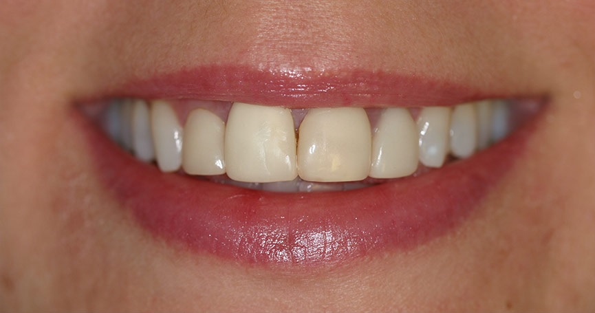 gaps between teeth before composite veneers is applied