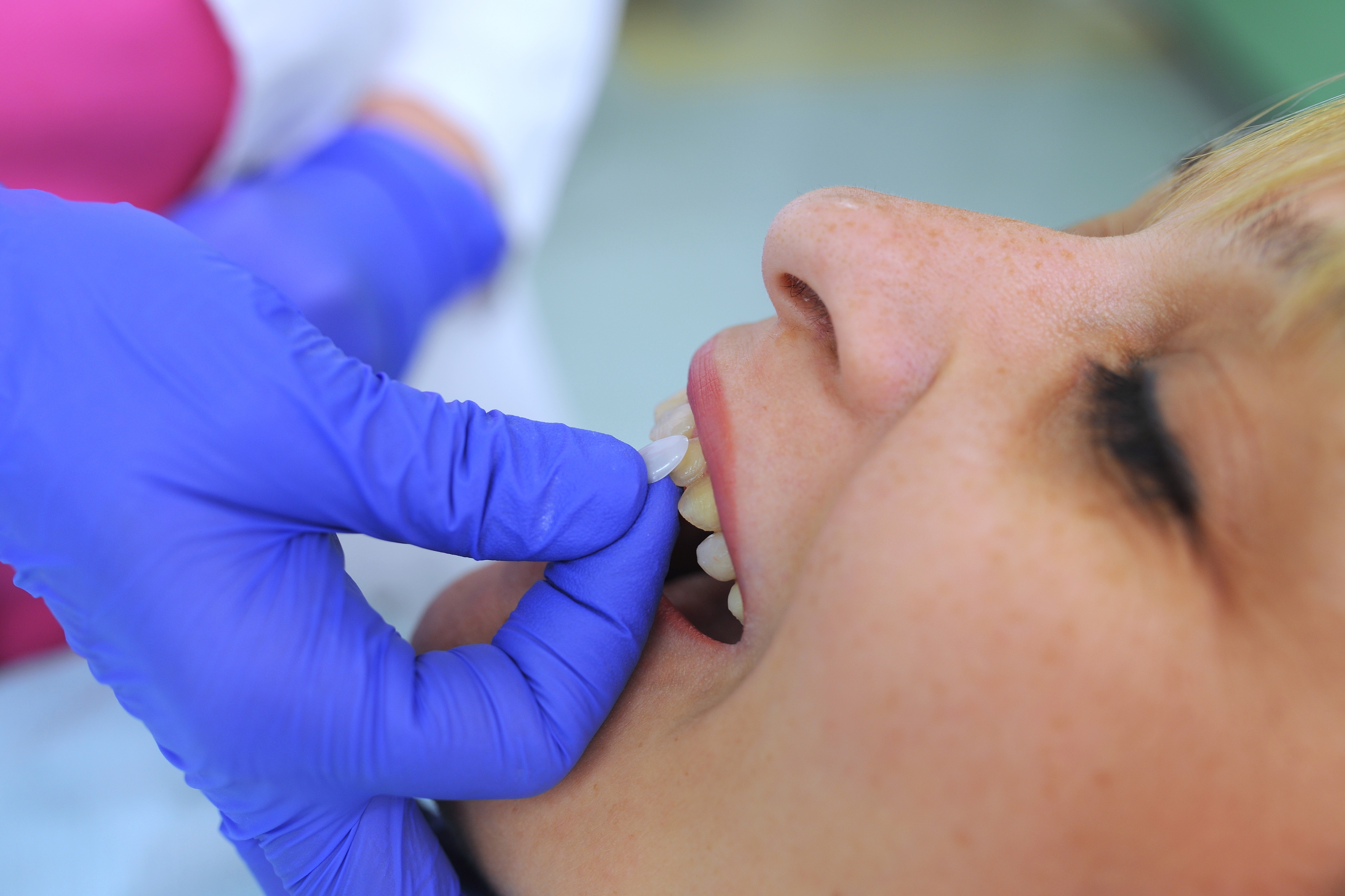 young woman gets dental veneer treatment at dental practice