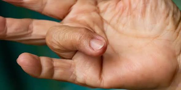 Pattanó ujj műtét – EA Beauty Medical