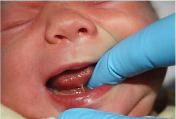 Tongue Tie Assessment