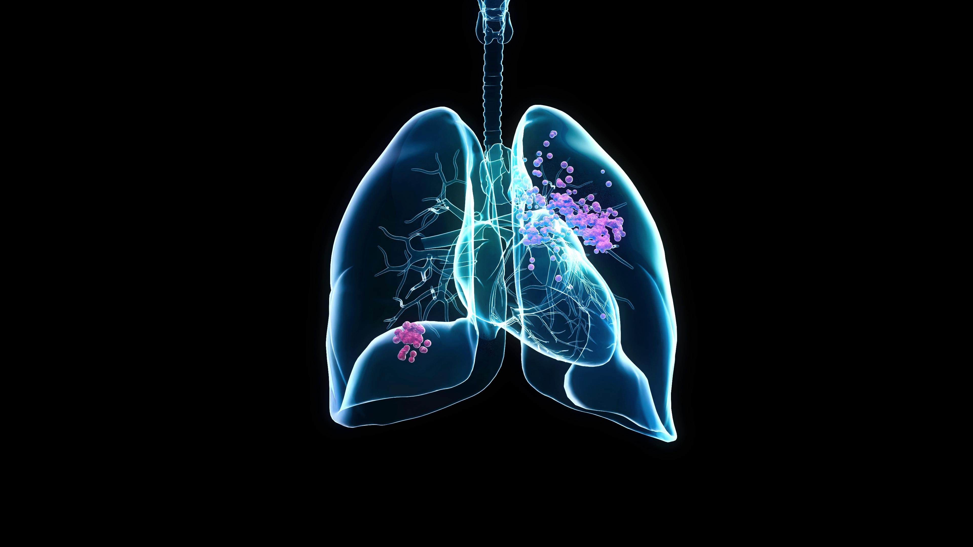 Lung cancer screening