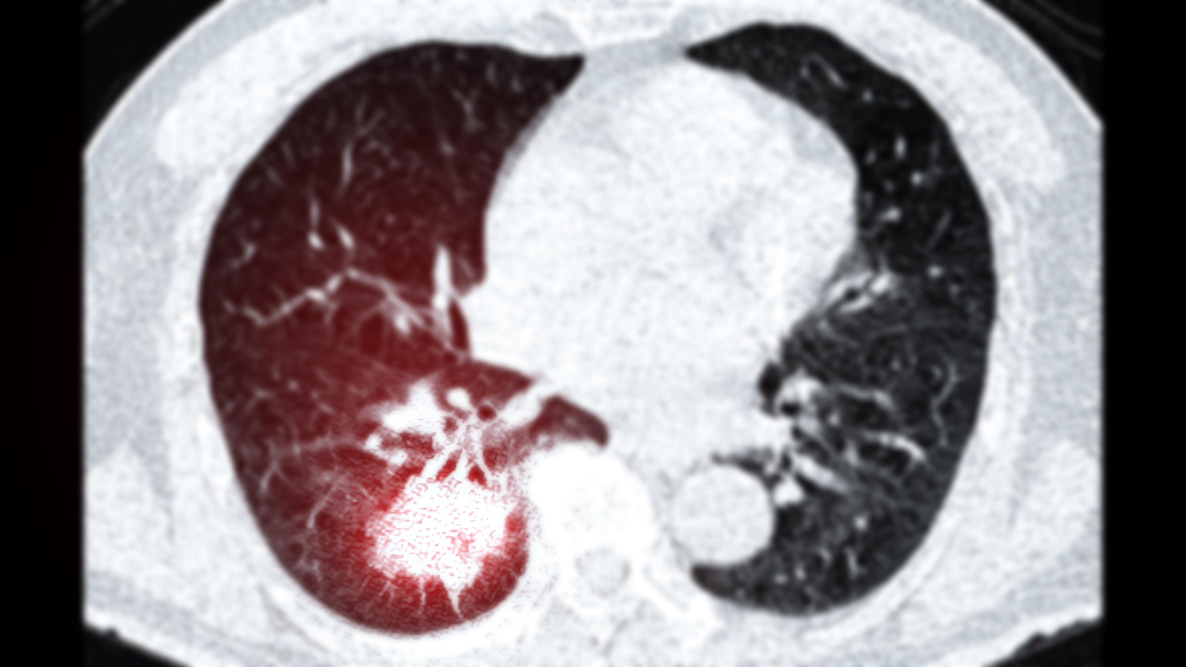 Lung Cancer CT