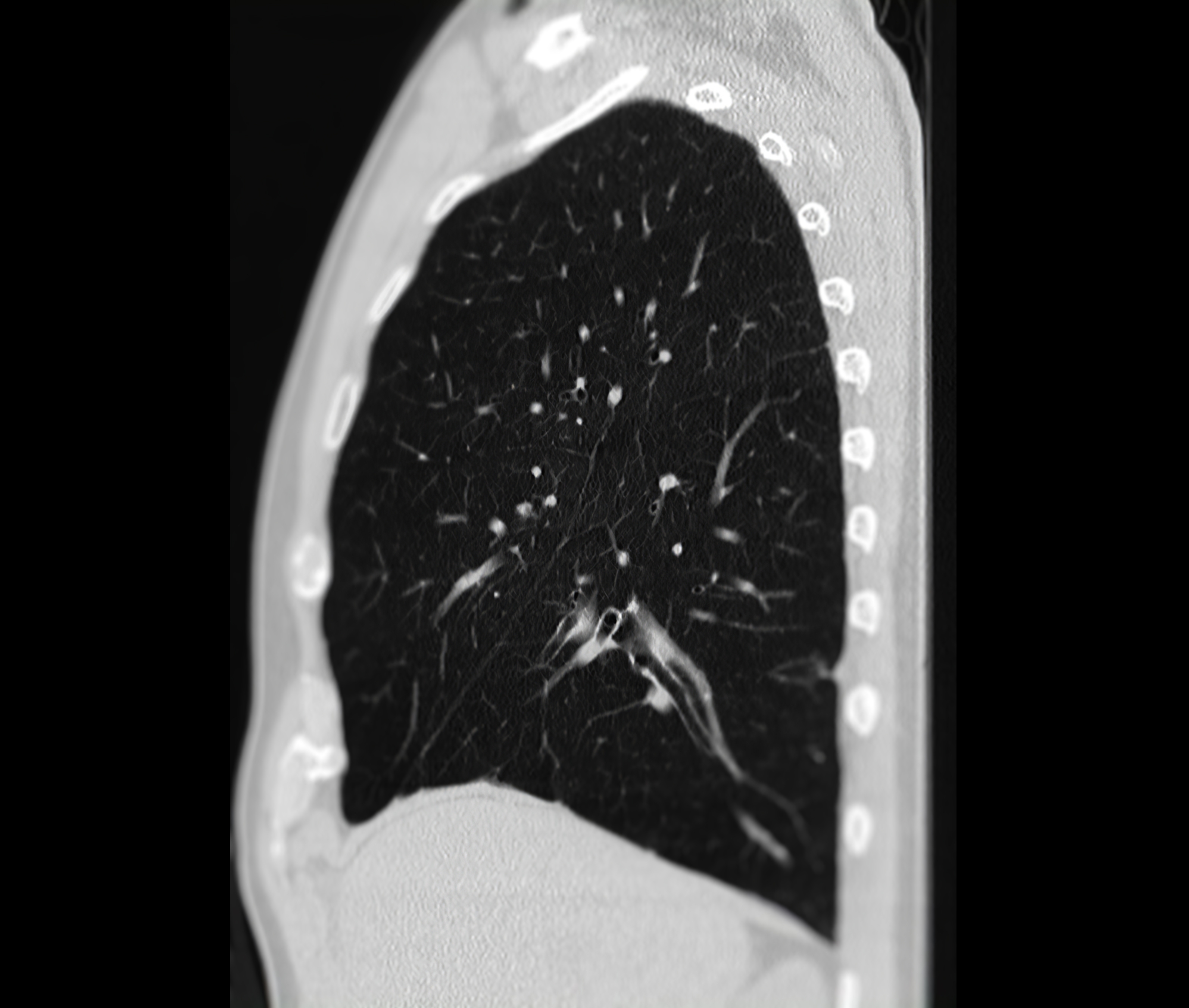 Lung CT Scan