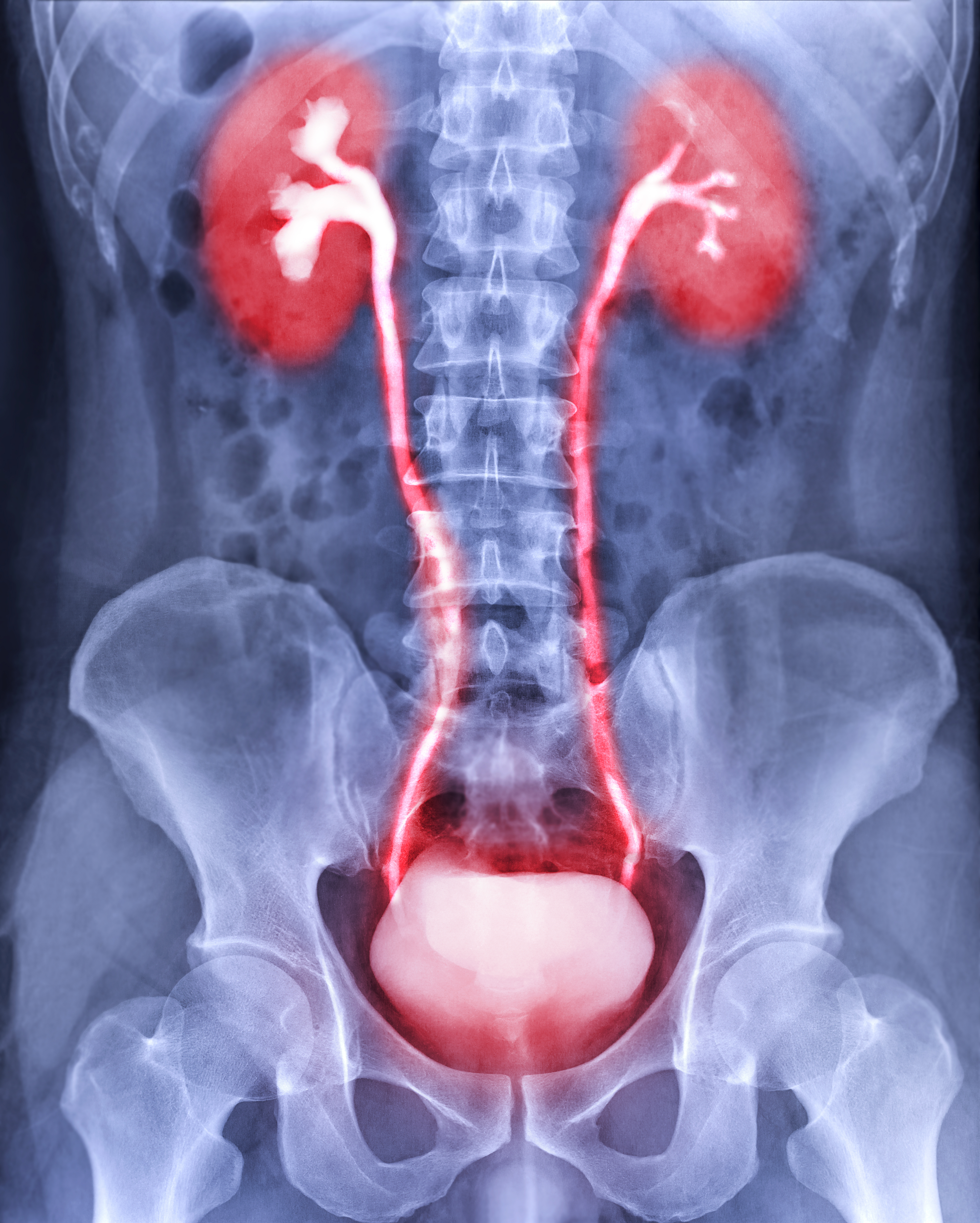 Contrast media in a kidney Contrast media in a kidney