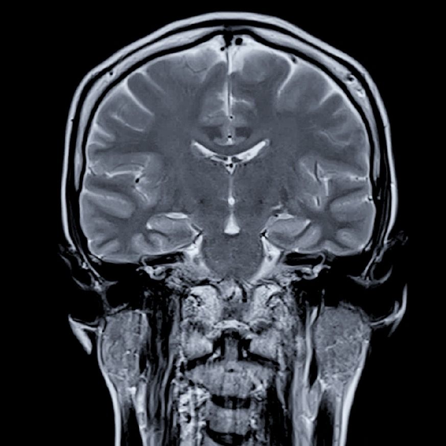 Brain MRI for Stroke Disease Brain MRI for Stroke Disease