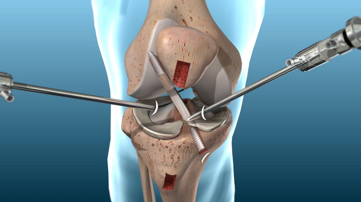 acl reconstruction surgery