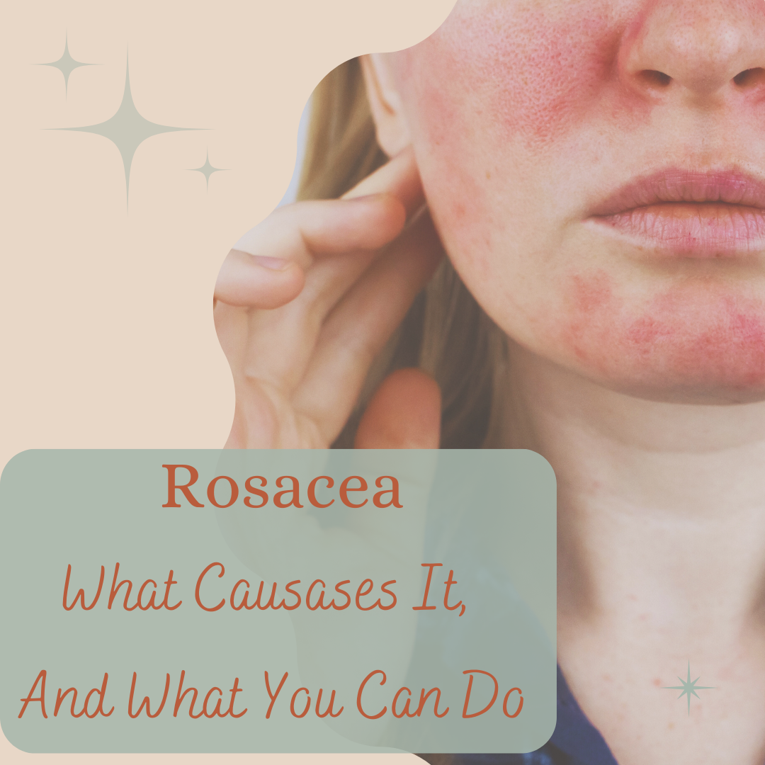 Rosacea , how to care for it , what is rosacea Rosacea , how to care for it , what is rosacea