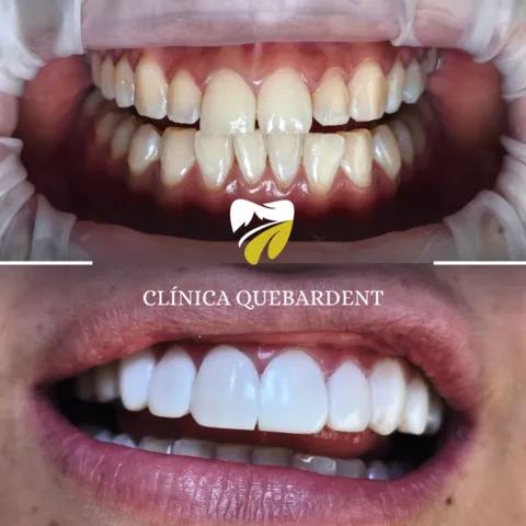 Caso clínico de estética dental