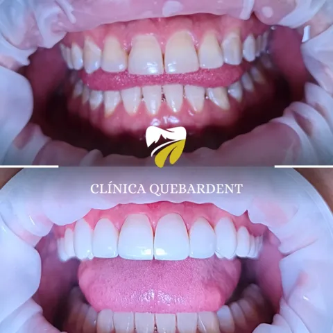 Resultado de sonrisa con carillas nanohíbridas