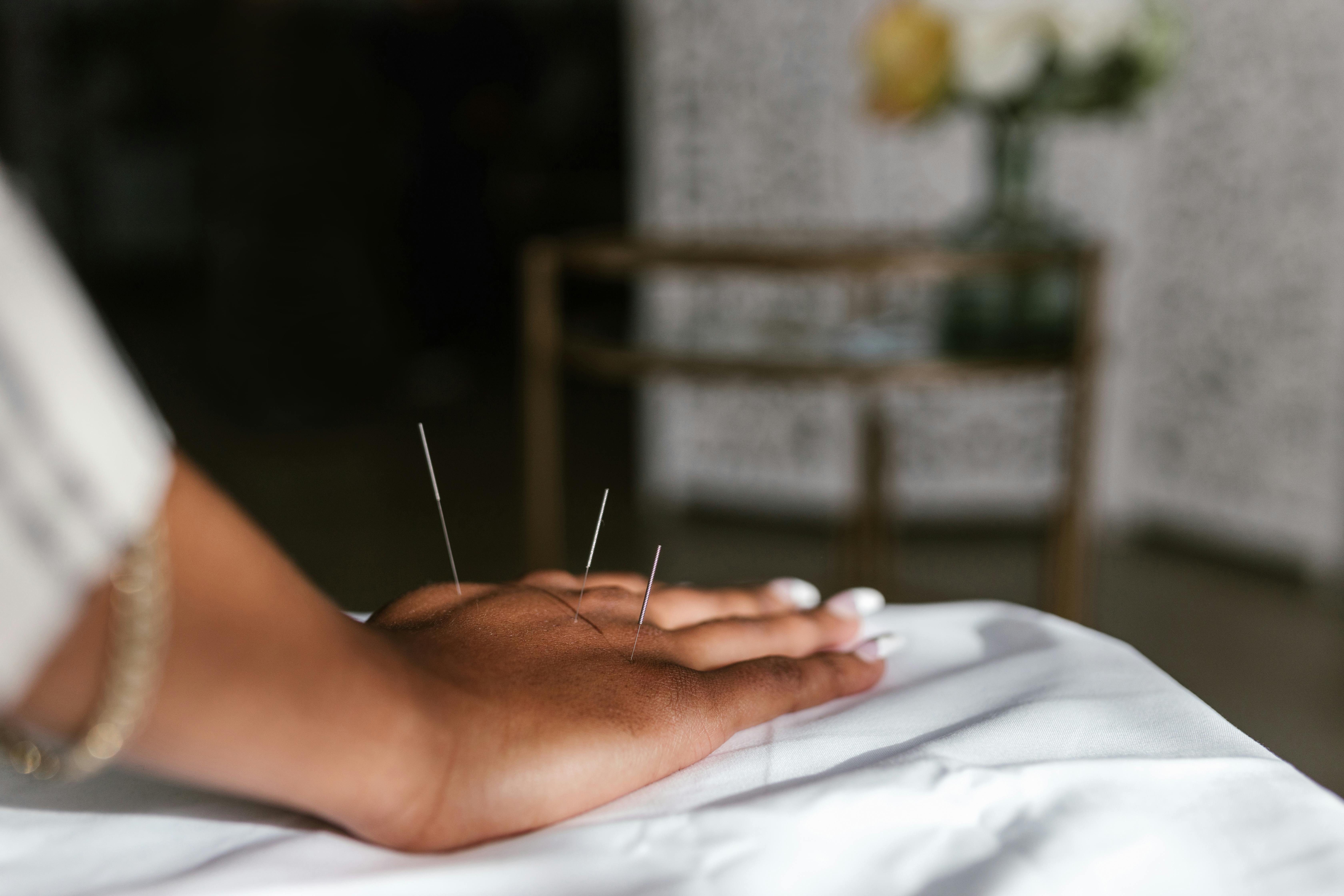 Close-up of acupuncture needles gently inserted into a patient’s hand for pain relief and healing.