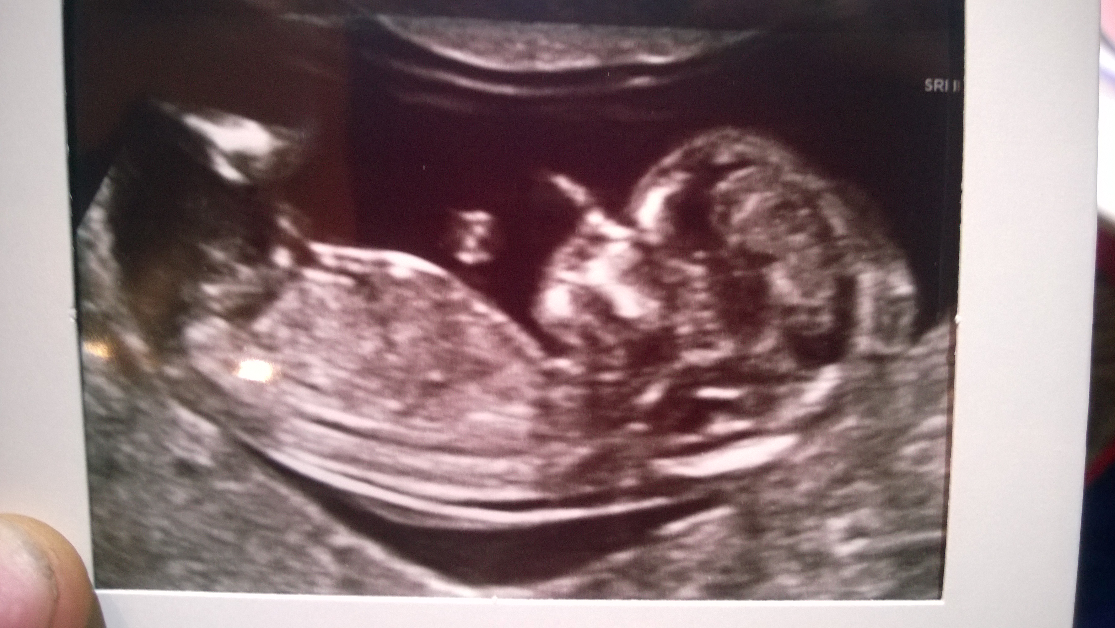 ultrasound of Zoe's first baby in 2014 ultrasound of Zoe's first baby in 2014