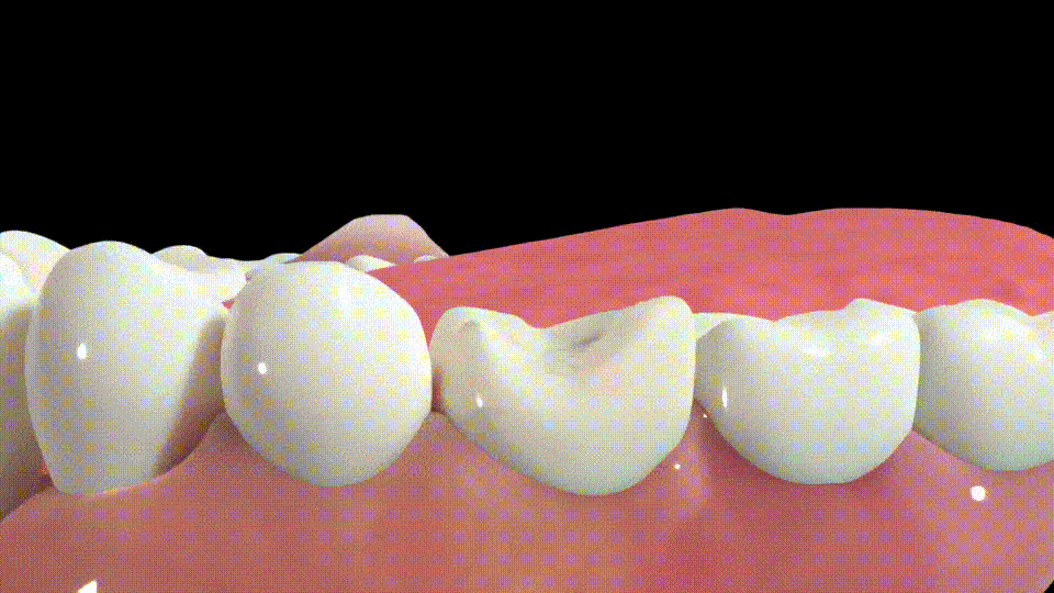 Tooth Extraction Illustration