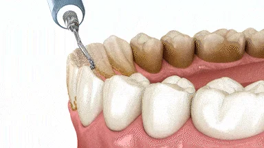 Dental implant illustration