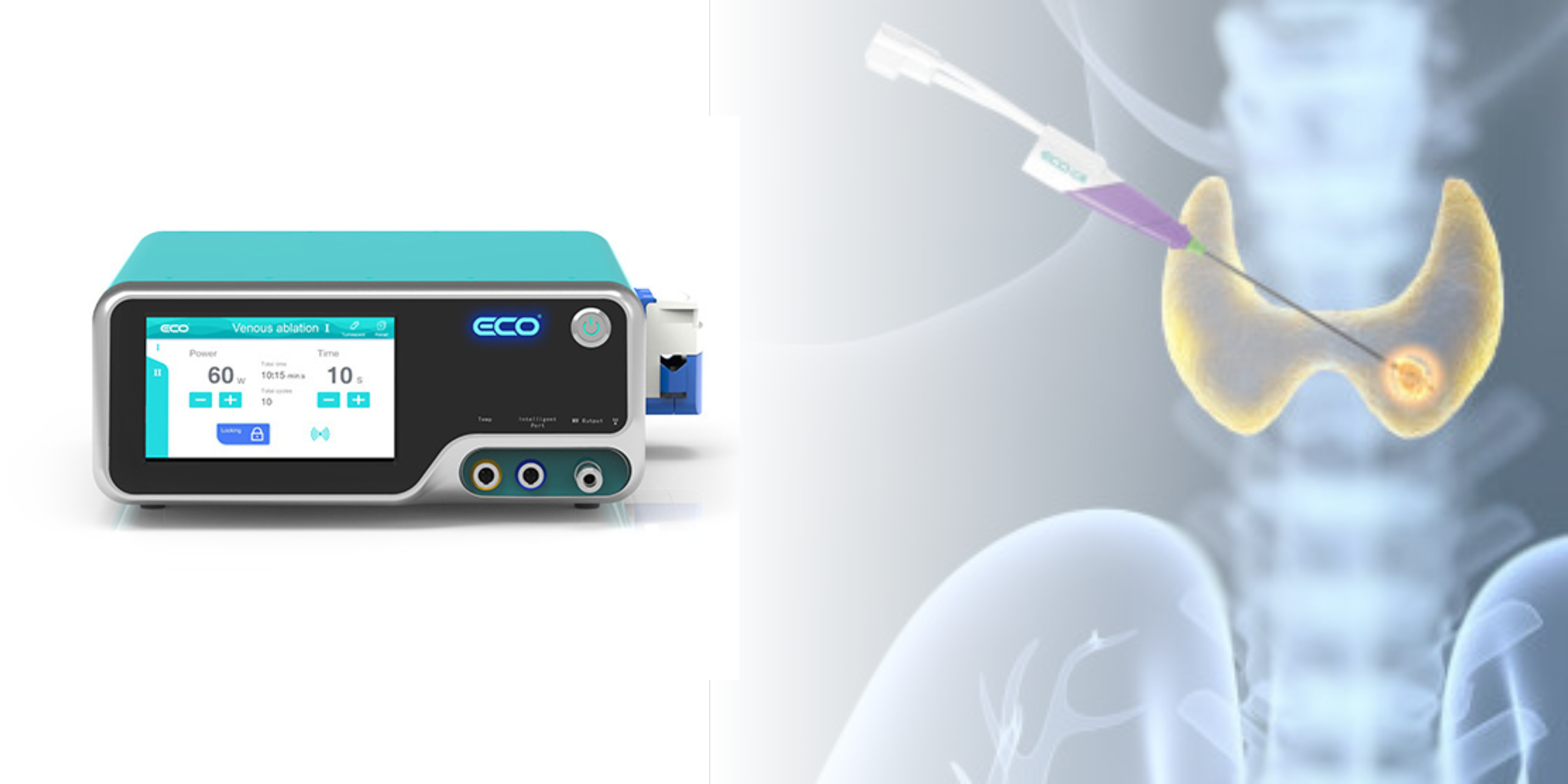 ECO MWA, eco microwave, termo ablacion, ablacion por microondas, ablacion, ablasion de tiroides ECO MWA, eco microwave, termo ablacion, ablacion por microondas, ablacion, ablasion de tiroides