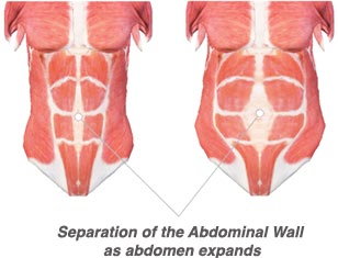 Rectus Abdominis Diastasis