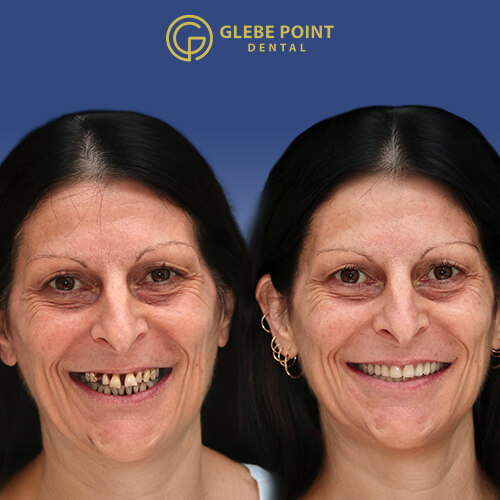 Before and after dental treatment showing improved teeth appearance 7