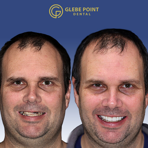 Before and after dental treatment showing improved teeth appearance 4