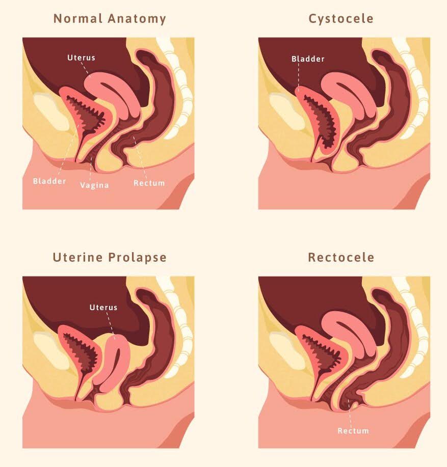 pelvic organ prolapse pelvic organ prolapse