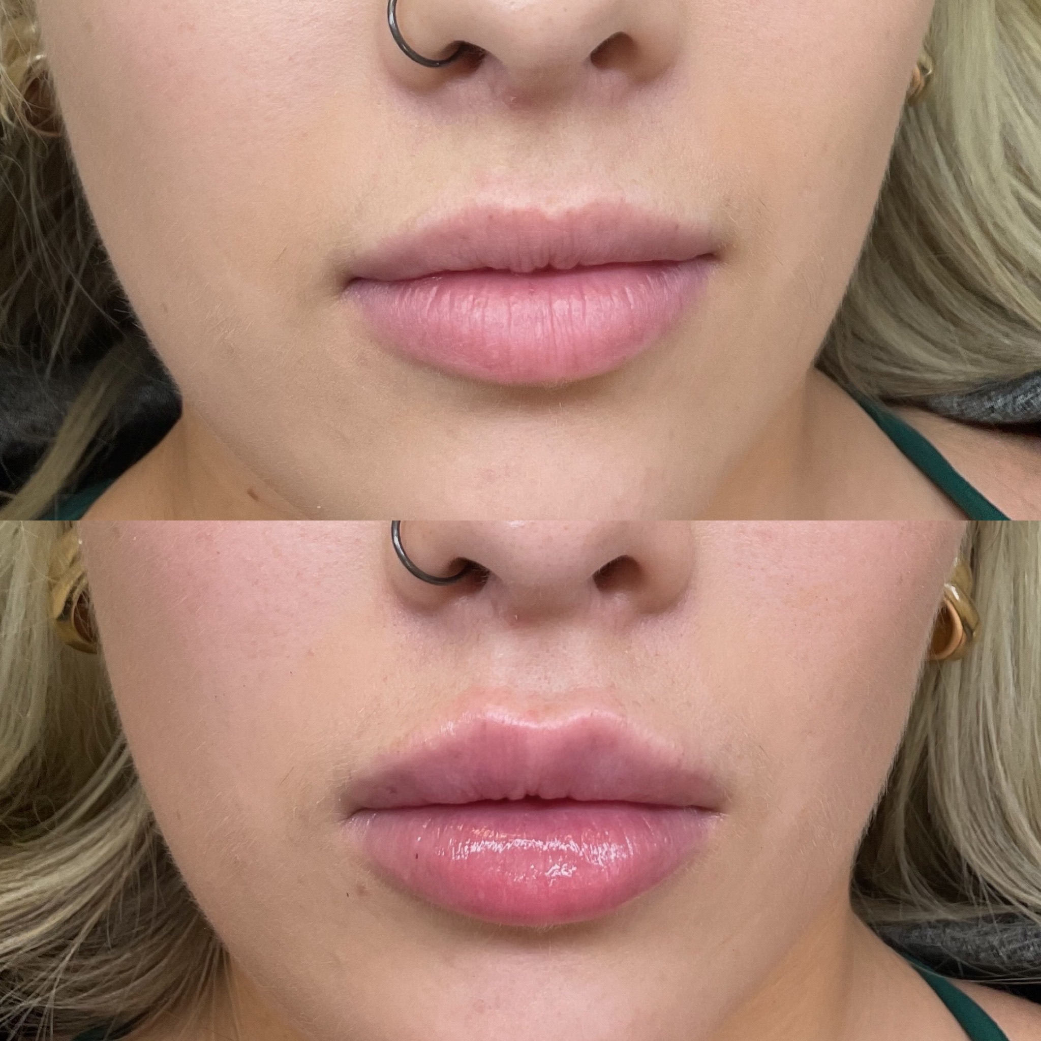 Lip filler in denver