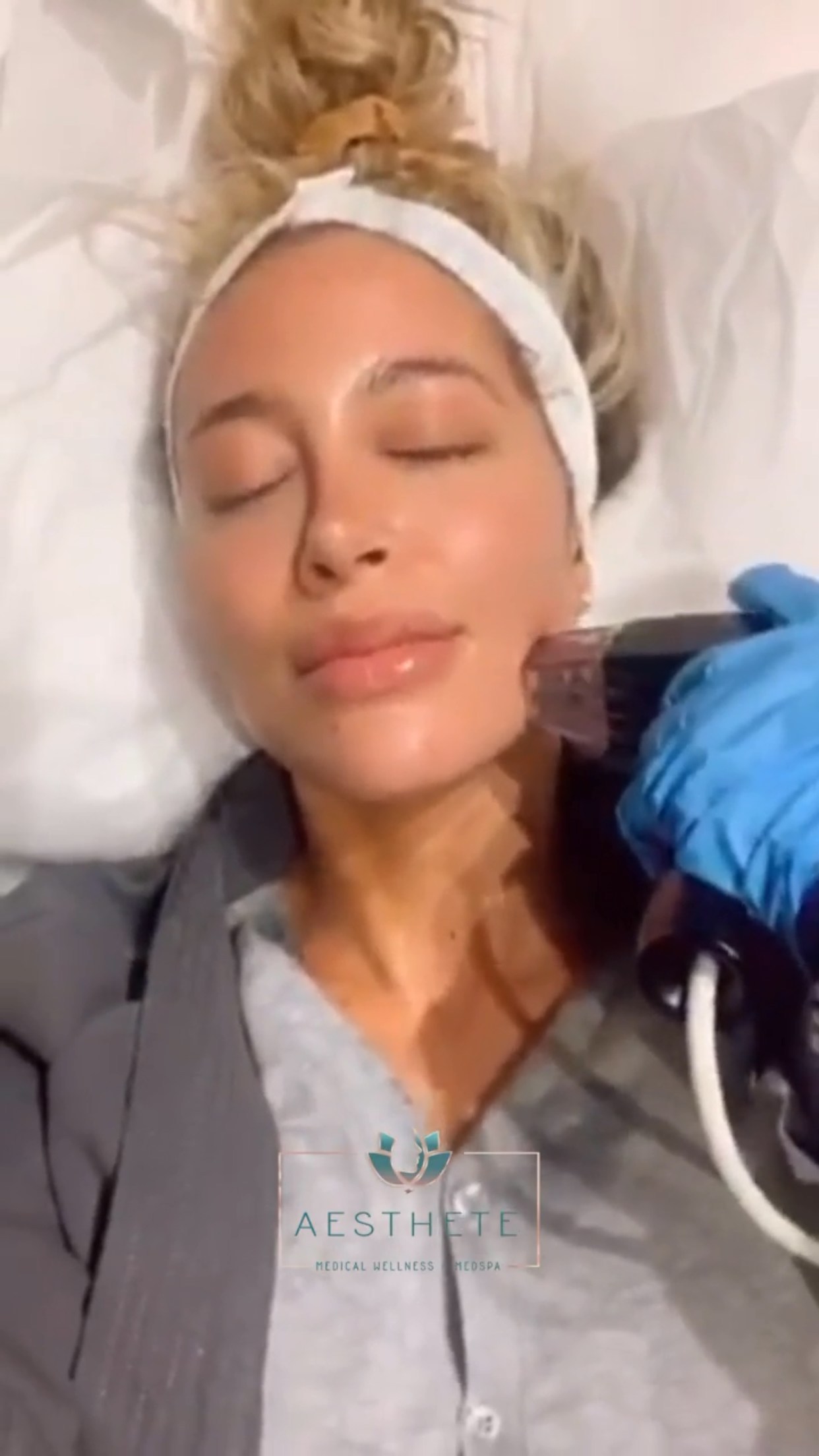 Morpheus 8 Microneedling