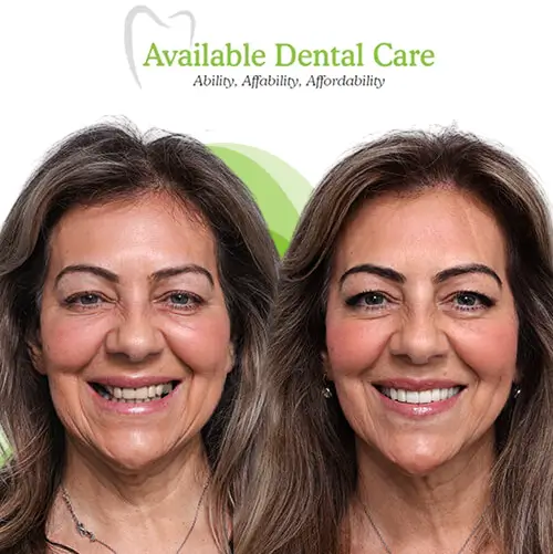 Before and after dental treatment showing improved teeth appearance 5