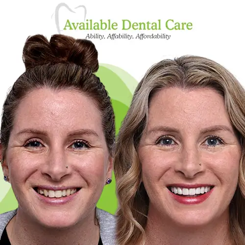 Before and after dental treatment showing improved teeth appearance 4