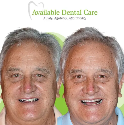 Before and after dental treatment showing improved teeth appearance 1