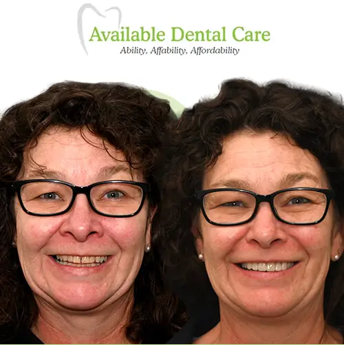 Before and after dental treatment showing improved teeth appearance 2