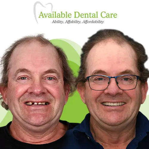 Before and after dental treatment showing improved teeth appearance 3