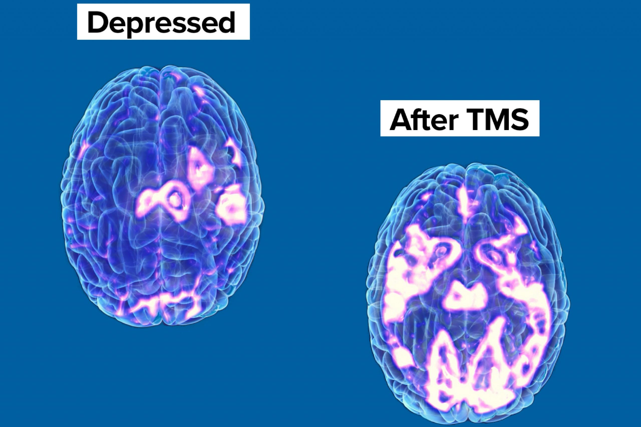 Before and after brain scans with TMS Therapy