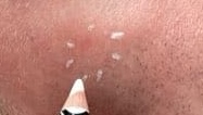 Actinic Keratoses My Skin St Pete My Skin Bradenton