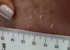 Actinic Keratoses My Skin St Pete My Skin Bradenton