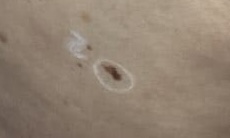 Melanoma My Skin St Pete My Skin Bradenton