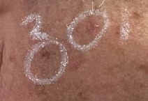 Squamous Cell Carcinoma My Skin St Pete My Skin Bradenton